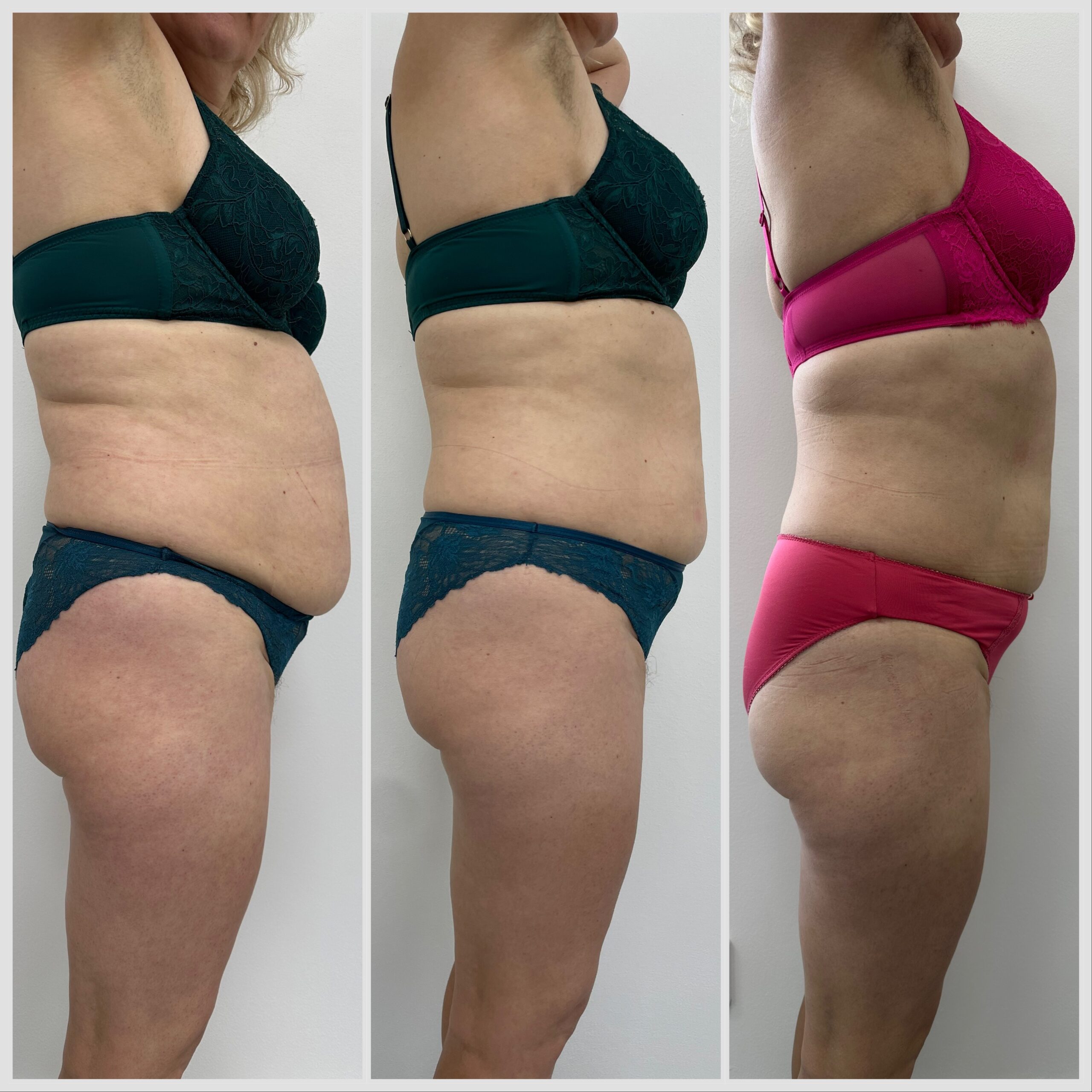 8x sezení s EMS bodysculpt