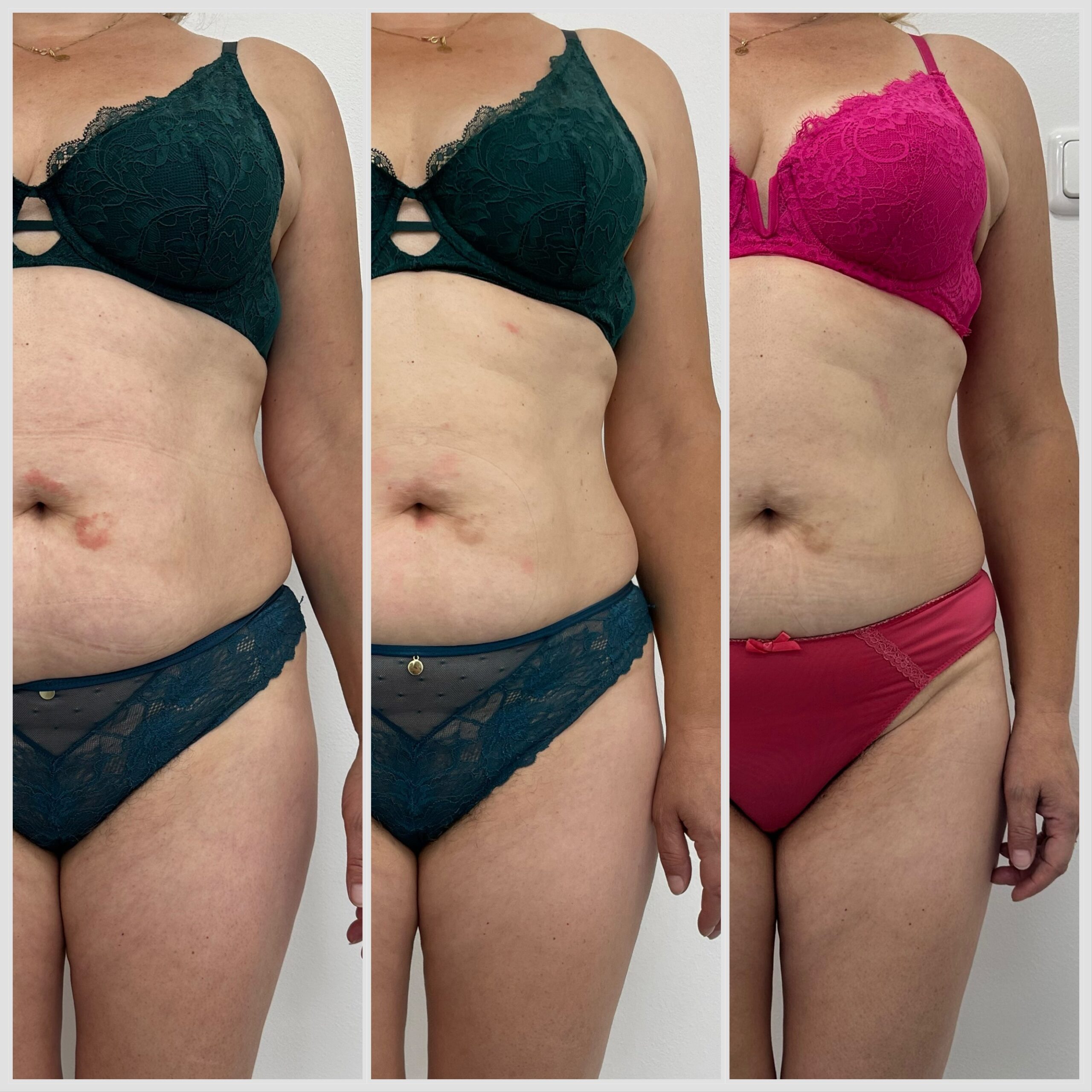 8x sezení s EMS bodysculpt